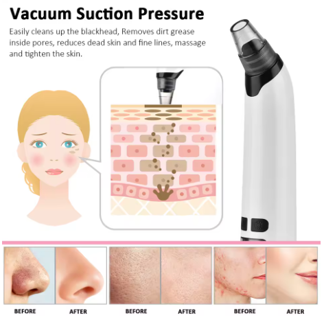 CleaNice Blackhead Remover Vacuum