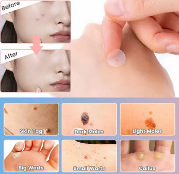 CleaNice Anti-Acne Concealer Patch